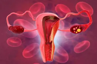 Tumore dell’ovaio, una donna su tre aspetta più di un anno per la diagnosi